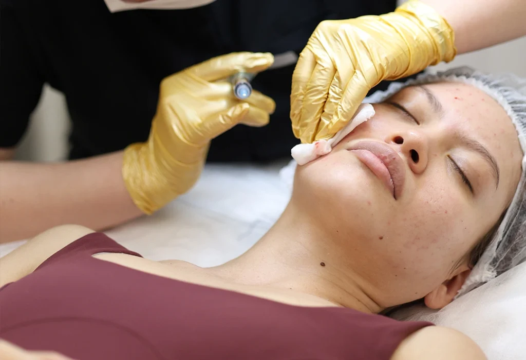 Mezoterapia igłowa