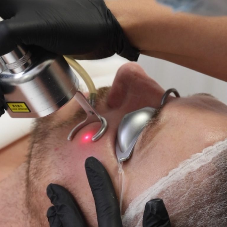 Laser frakcyjny