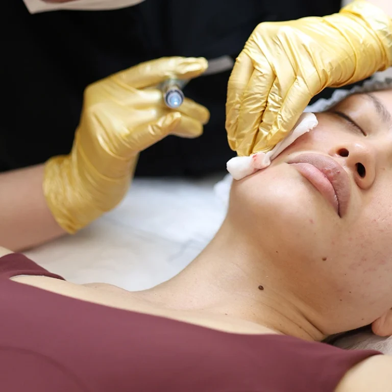 Mezoterapia igłowa
